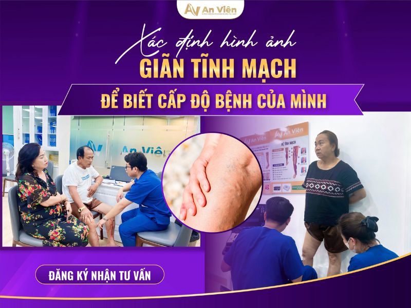 chân bị nổi mạch máu đỏ