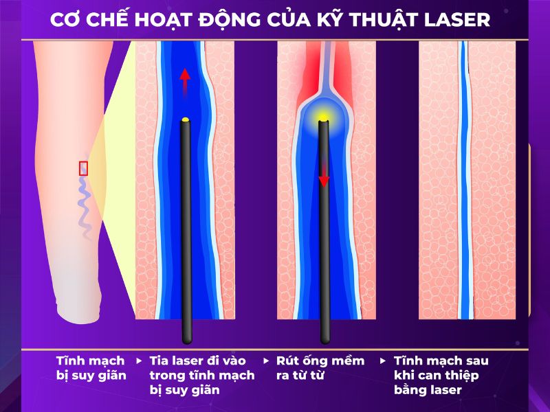 chân bị suy giãn tĩnh mạch