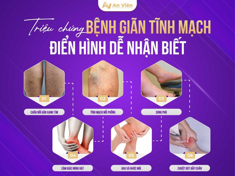 dấu hiệu bị giãn tĩnh mạch chân