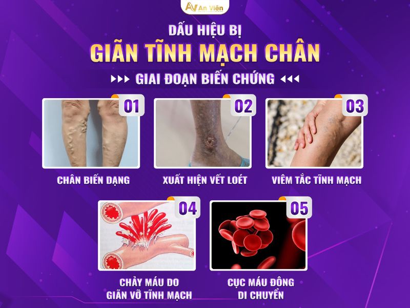 dấu hiệu bị giãn tĩnh mạch chân