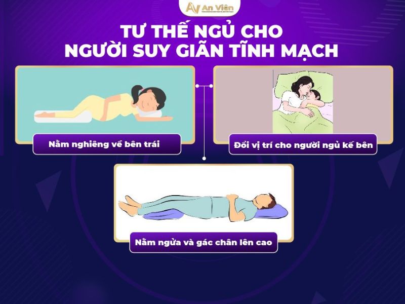 Dấu hiệu chân bị giãn tĩnh mạch do đứng lâu ngồi nhiều 17 dấu hiệu chân bị giãn tĩnh mạch