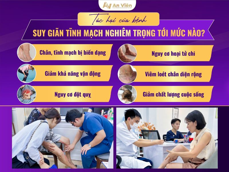 Dấu hiệu chân bị giãn tĩnh mạch do đứng lâu ngồi nhiều 13 dấu hiệu chân bị giãn tĩnh mạch