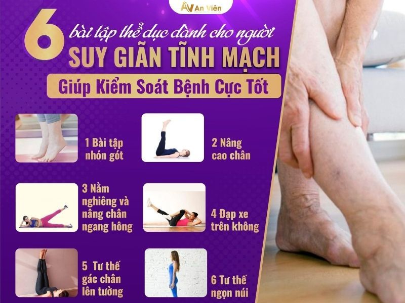 Dấu hiệu chân bị giãn tĩnh mạch do đứng lâu ngồi nhiều 18 dấu hiệu chân bị giãn tĩnh mạch