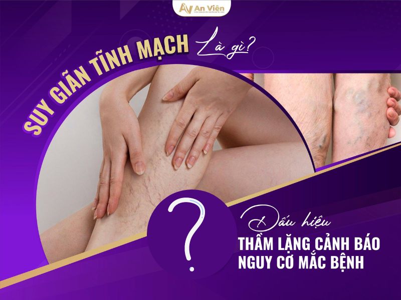 triệu chứng giãn tĩnh mạch ở chân