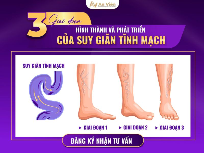 triệu chứng giãn tĩnh mạch ở chân