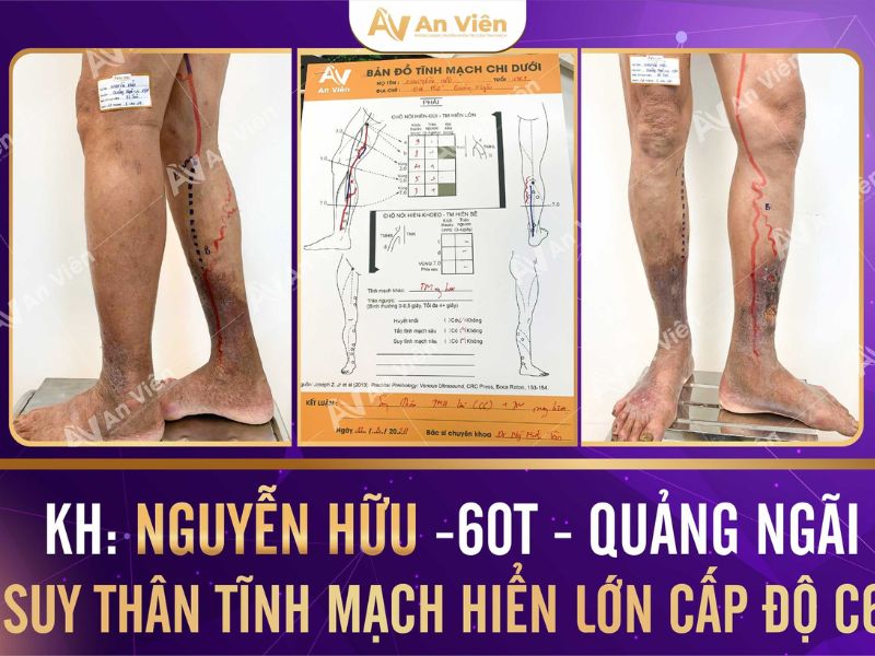 Xếp hạng 5 cơ sở y tế bệnh suy tĩnh mạch uy tín tại TPHCM 15 bệnh suy tĩnh mạch