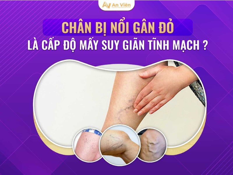 6 cách trị nổi gân tay chân hữu hiệu từ nguyên liệu tự nhiên 13 cách trị nổi gân tay chân