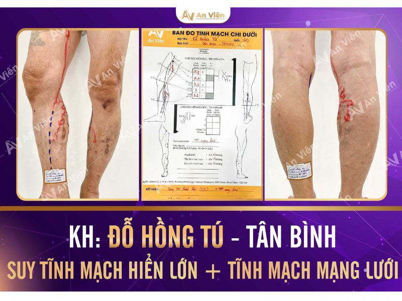 Dấu hiệu bệnh giãn tĩnh mạch chi dưới và 3 địa chỉ chữa 10 dấu hiệu bệnh giãn tĩnh mạch chi dưới