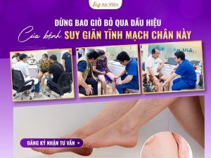 dấu hiệu bệnh giãn tĩnh mạch chi dưới