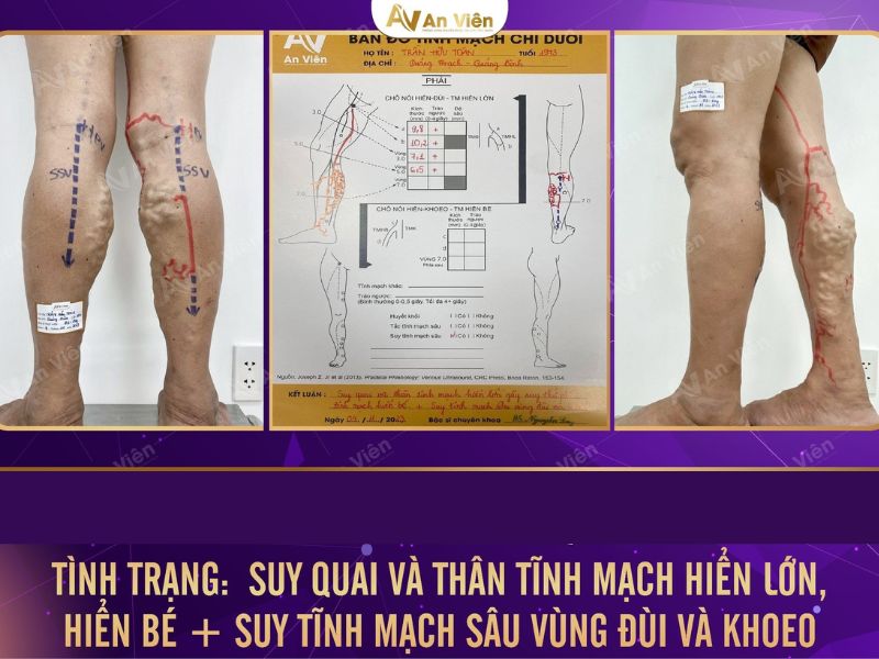 dấu hiệu của bệnh giãn tĩnh mạch