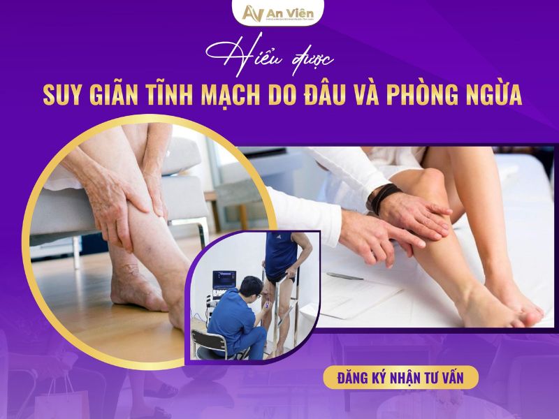 Mùa hè - Cẩn thận triệu chứng giãn tĩnh mạch ở chân tăng nặng 10 triệu chứng giãn tĩnh mạch ở chân