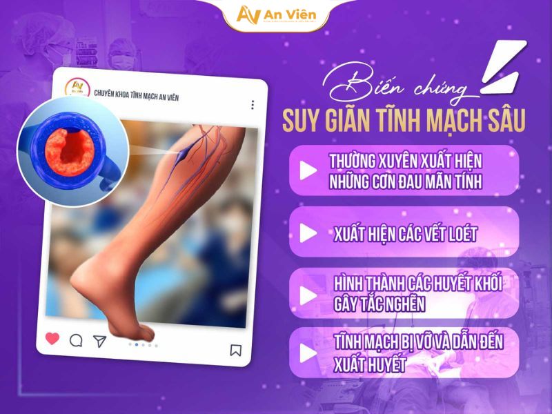 Suy van tĩnh mạch sâu chi dưới hai bên: Nguyên nhân, triệu chứng, biến chứng nguy hiểm 12 Suy van tĩnh mạch sâu chi dưới hai bên