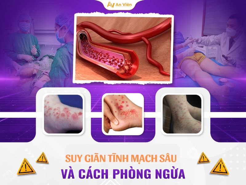 Suy van tĩnh mạch sâu chi dưới hai bên: Nguyên nhân, triệu chứng, biến chứng nguy hiểm 13 Suy van tĩnh mạch sâu chi dưới hai bên