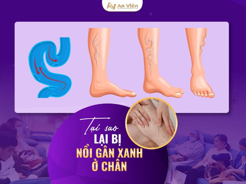 Chuột rút có phải biểu hiện bệnh giãn tĩnh mạch chân không? 10 biểu hiện bệnh giãn tĩnh mạch chân