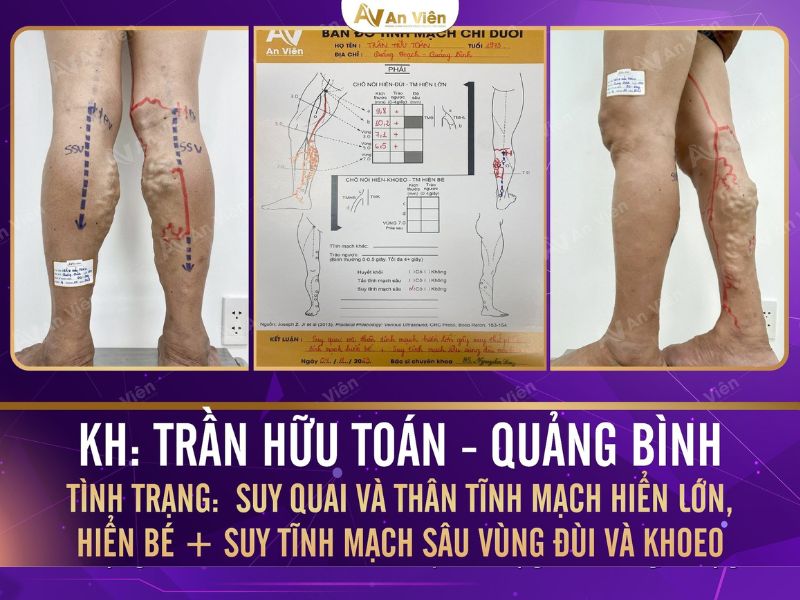 biểu hiện của giãn tĩnh mạch chân