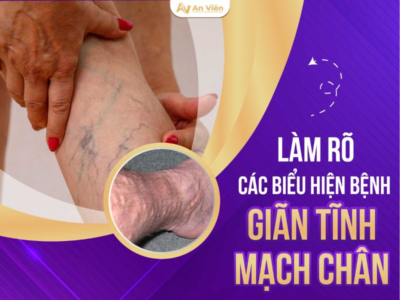biểu hiện của giãn tĩnh mạch chân