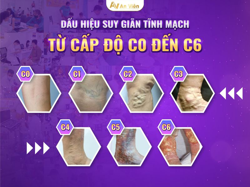 cách điều trị bệnh giãn tĩnh mạch