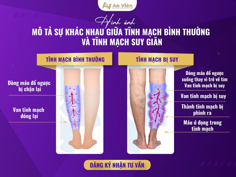 cách điều trị bệnh giãn tĩnh mạch