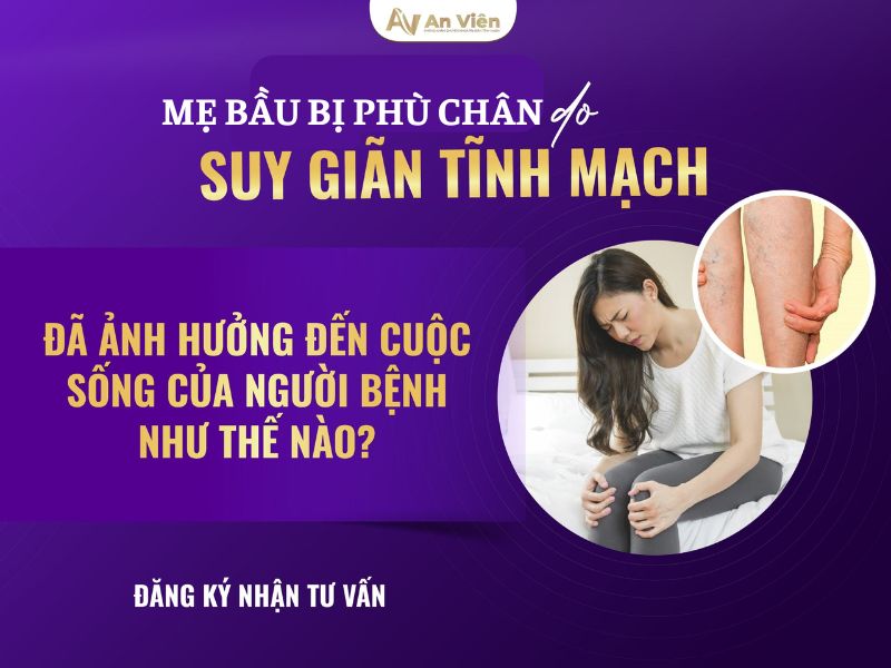 Dấu hiệu suy giãn tĩnh mạch chi dưới mẹ bầu: Phù chân 12 dấu hiệu suy giãn tĩnh mạch chi dưới