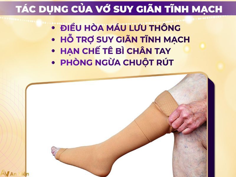 giãn tĩnh mạch là như thế nào