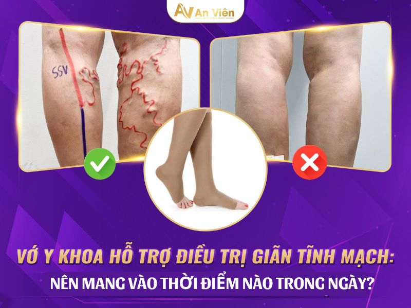 giãn tĩnh mạch là như thế nào