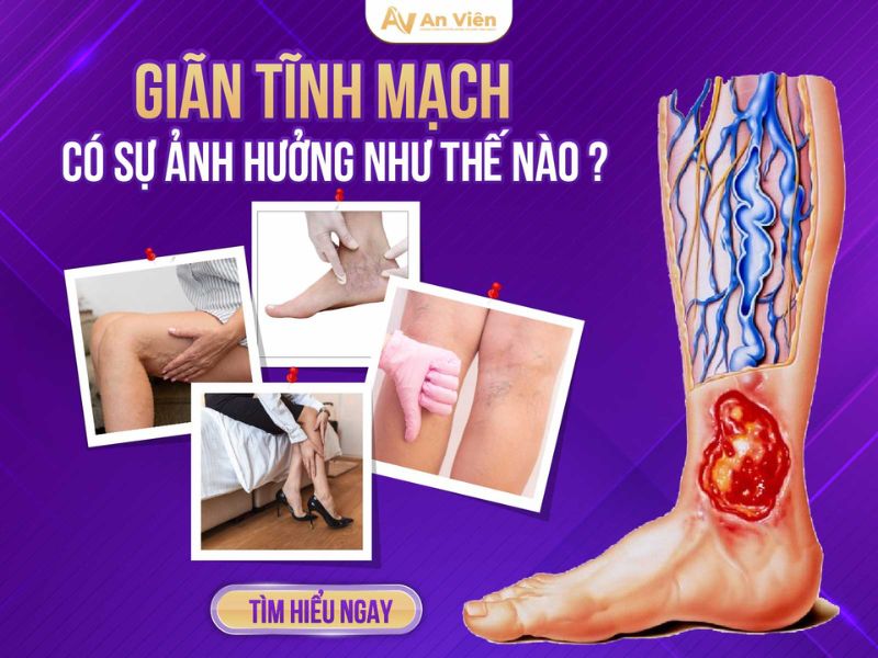 giãn tĩnh mạch là như thế nào