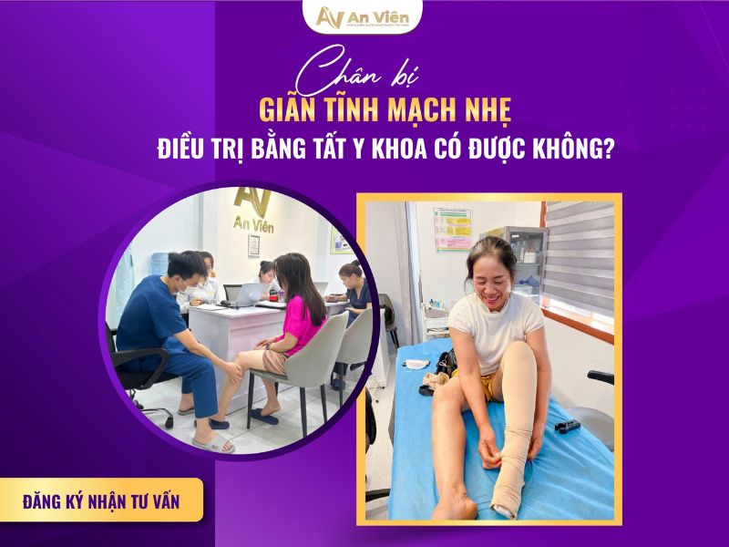 phòng chống giãn tĩnh mạch