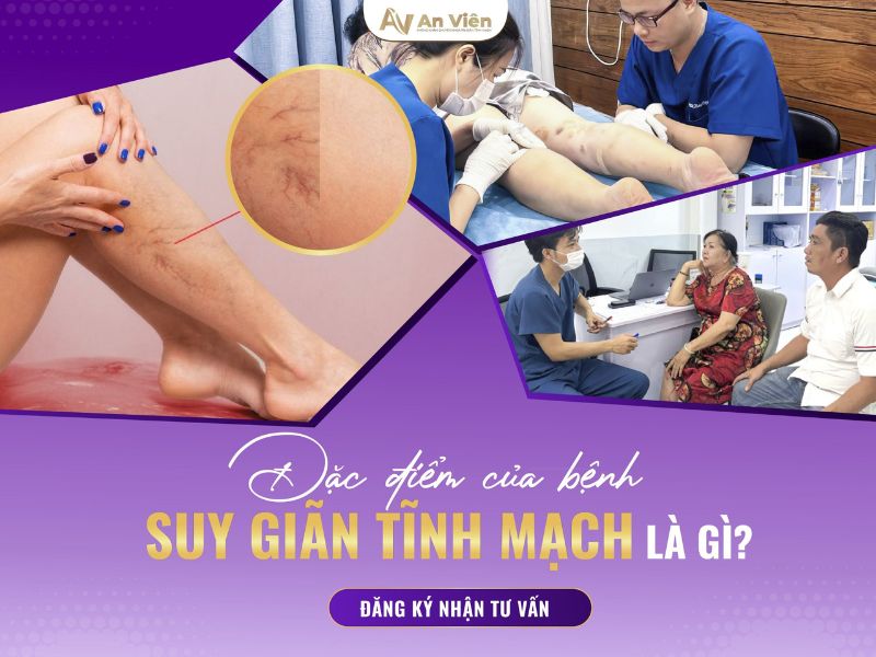 đau giãn tĩnh mạch chân