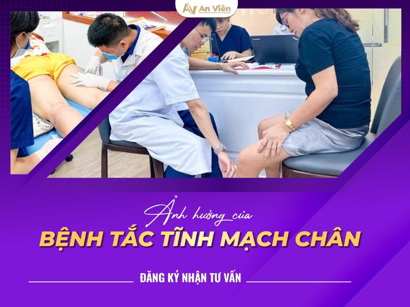 đau giãn tĩnh mạch chân