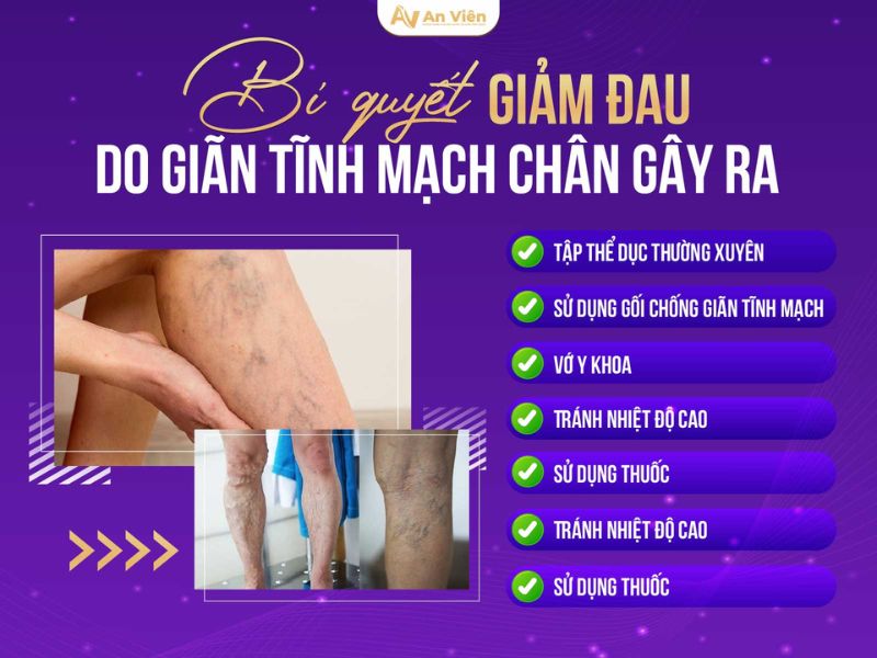 đau giãn tĩnh mạch chân