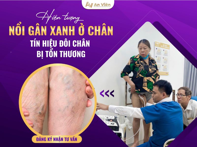 giãn tĩnh mạch nổi gân xanh