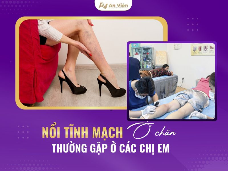 nguyên nhân suy tĩnh mạch