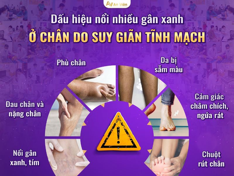 Nổi nhiều gân xanh ở chân do bệnh giãn tĩnh mạch gây ra 12 nổi nhiều gân xanh ở chân