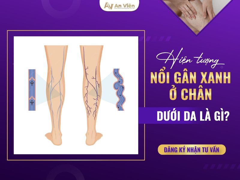 Nổi nhiều gân xanh ở chân do bệnh giãn tĩnh mạch gây ra 11 nổi nhiều gân xanh ở chân