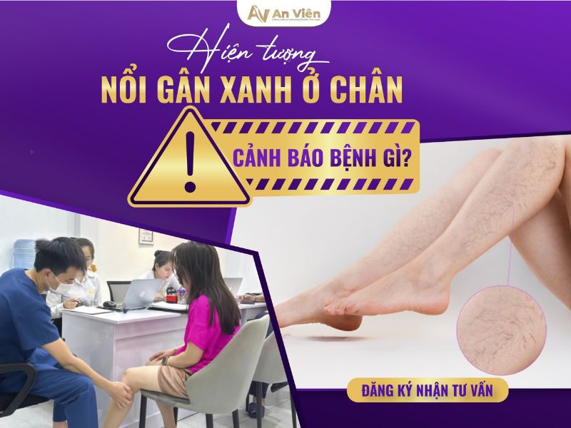 Nổi nhiều gân xanh ở chân do bệnh giãn tĩnh mạch gây ra 9 nổi nhiều gân xanh ở chân
