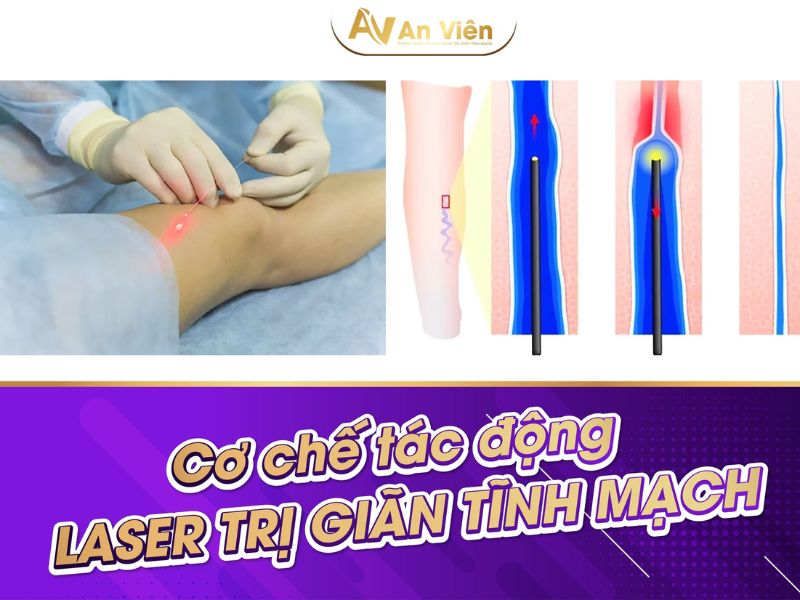 Nổi nhiều gân xanh ở chân do bệnh giãn tĩnh mạch gây ra 13 nổi nhiều gân xanh ở chân