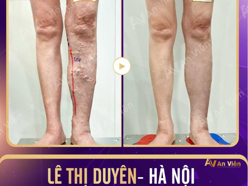 Nổi nhiều gân xanh ở chân do bệnh giãn tĩnh mạch gây ra 15 nổi nhiều gân xanh ở chân