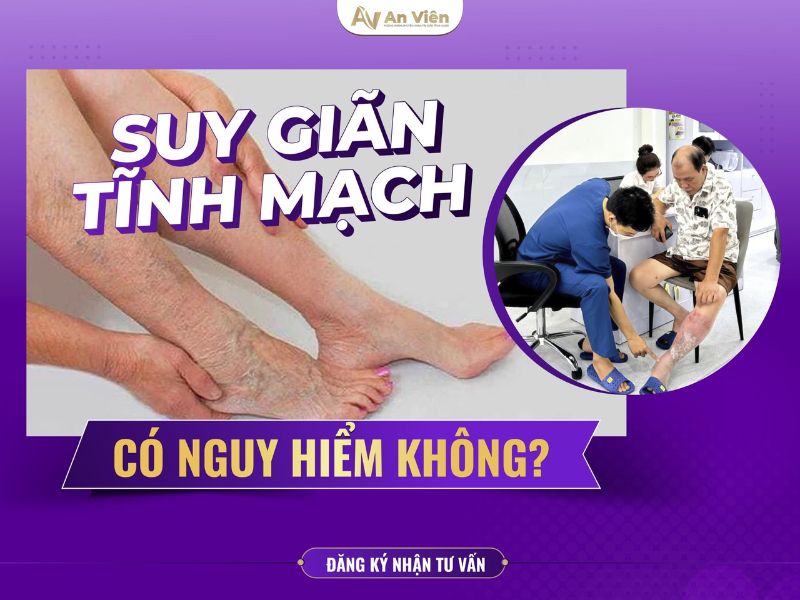 suy giãn tĩnh mạch chi dưới có nguy hiểm không
