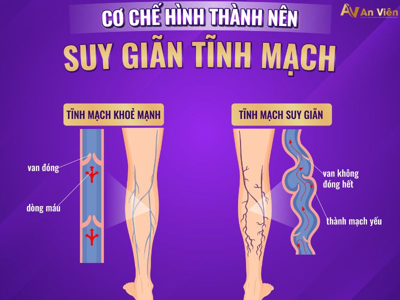 suy giãn tĩnh mạch chi dưới có nguy hiểm không