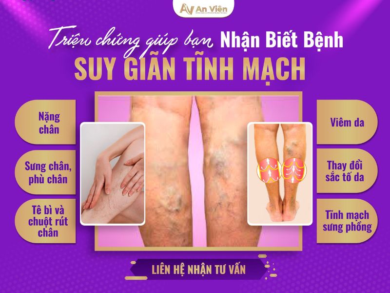 suy giãn tĩnh mạch chi dưới có nguy hiểm không