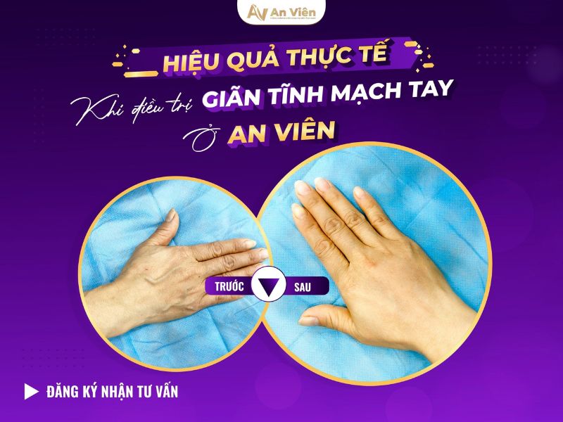 tay chân nhiều gân xanh