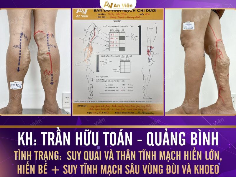 Tìm hiểu về bệnh giãn tĩnh mạch và 6 dấu hiệu bất thường 11 tìm hiểu về bệnh giãn tĩnh mạch