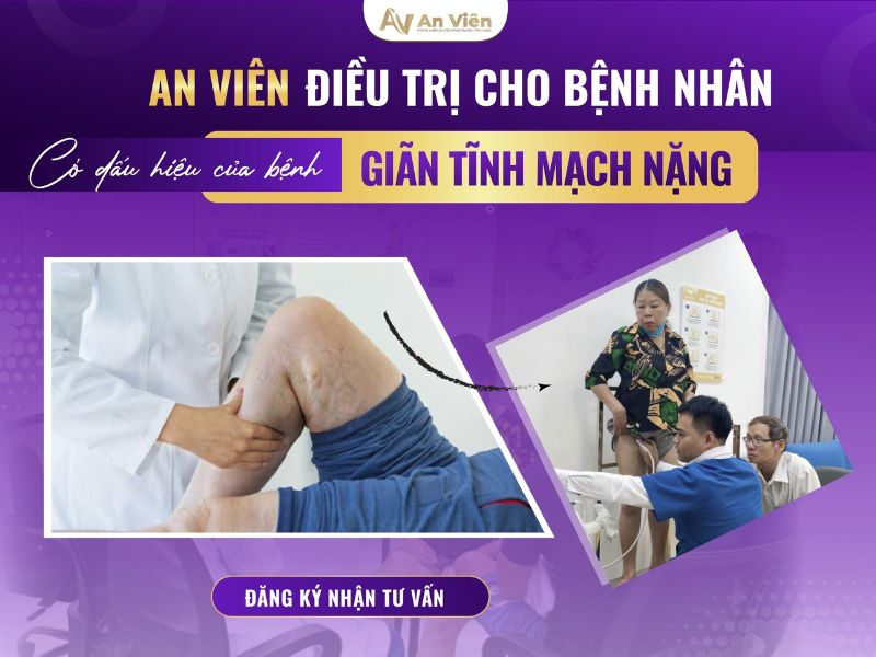 Tìm hiểu về bệnh giãn tĩnh mạch và 6 dấu hiệu bất thường 14 tìm hiểu về bệnh giãn tĩnh mạch