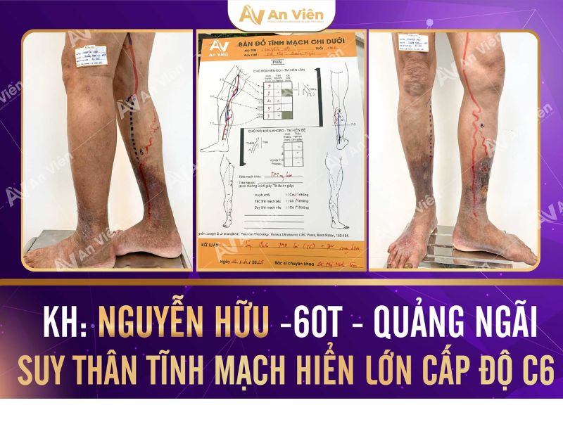 triệu chứng bệnh suy giãn tĩnh mạch chân