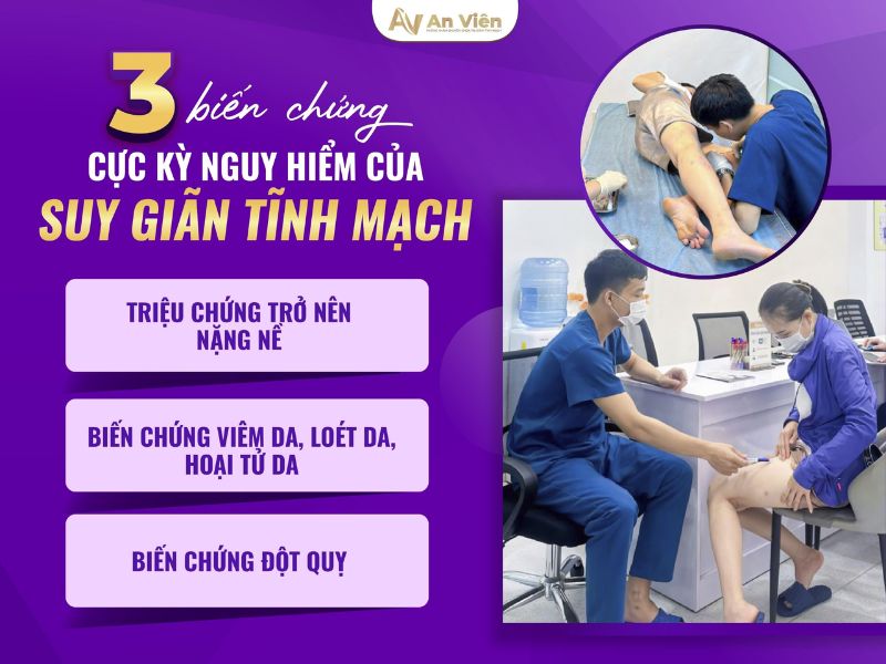 triệu chứng bệnh suy giãn tĩnh mạch chân