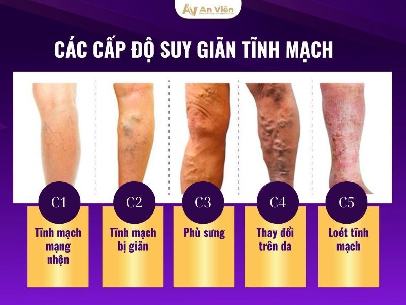 Nhận biết triệu chứng của suy giãn tĩnh mạch chân sớm 9 triệu chứng của suy giãn tĩnh mạch chân