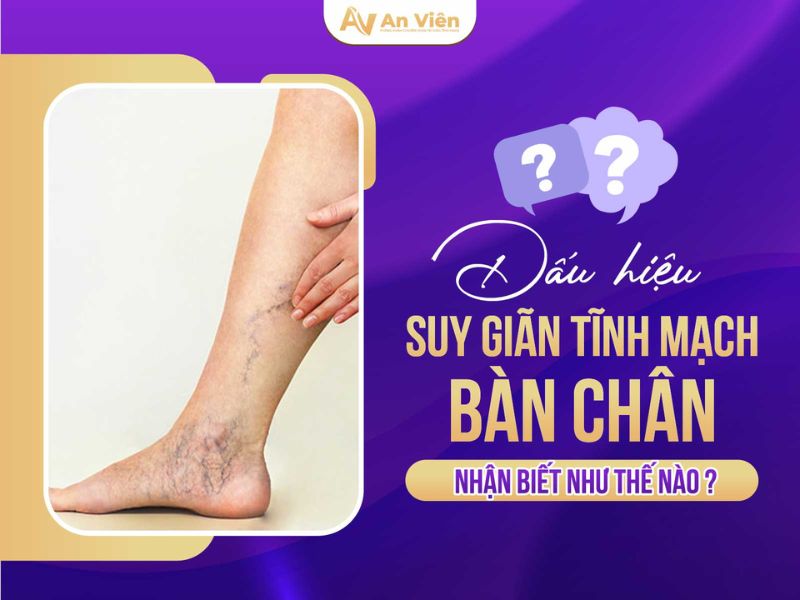 Nhận biết triệu chứng của suy giãn tĩnh mạch chân sớm 11 triệu chứng của suy giãn tĩnh mạch chân