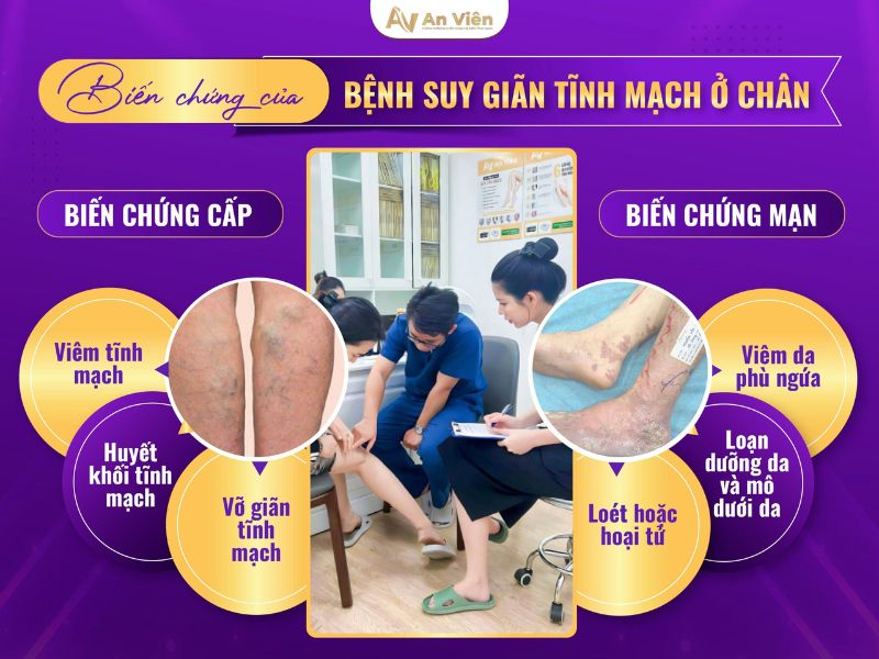 Nhận biết triệu chứng của suy giãn tĩnh mạch chân sớm 12 triệu chứng của suy giãn tĩnh mạch chân