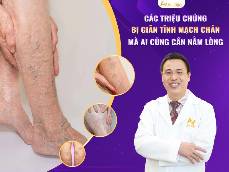 Triệu chứng suy giảm tĩnh mạch sẽ ra sao nếu để kéo dài? 11 triệu chứng suy giảm tĩnh mạch
