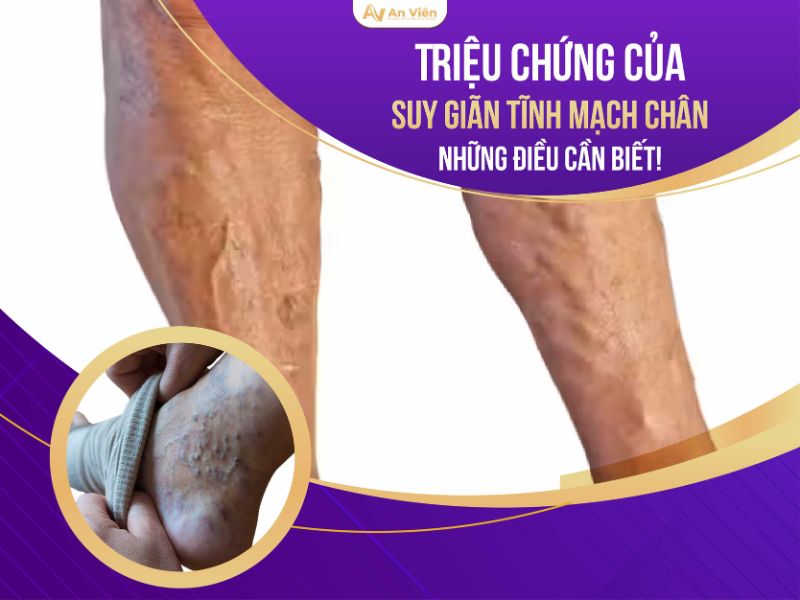 hình ảnh chân bị giãn tĩnh mạch